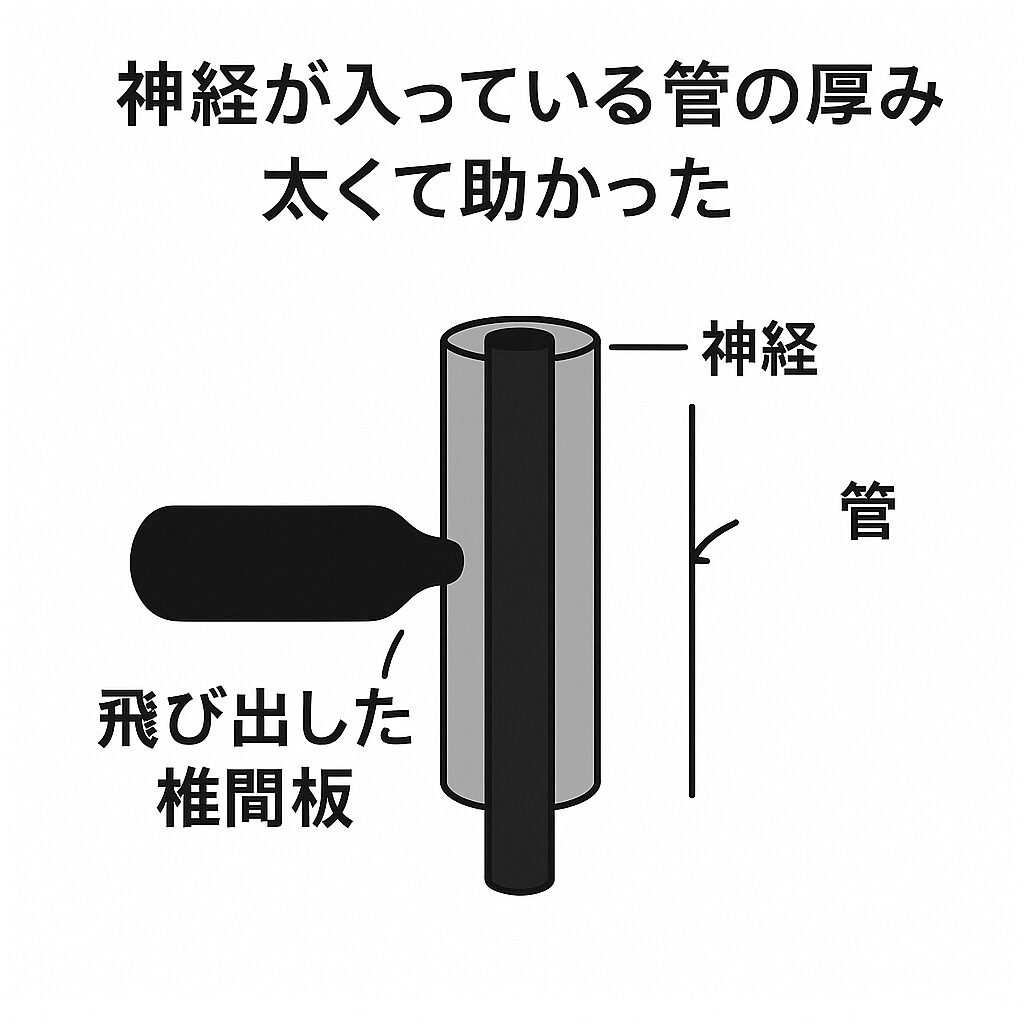 飛び出した椎間板と、神経が入っている管（ホース）を断面で示した図解。 太い管の中に神経が通っており、飛び出した椎間板が神経に接触しきっていない状態を表している。 上部には「神経が入っている管の厚み 太くて助かった」という解説が書かれている。 頸椎ヘルニアでも神経ホースの皮が厚いですね。